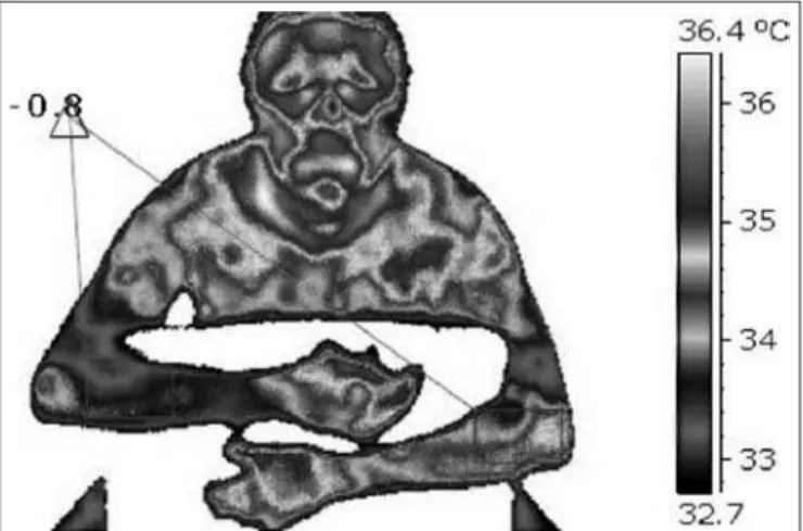 Figure 1. Infrared image showing central neurogenic pattern with  temperature difference of 0.8 o C