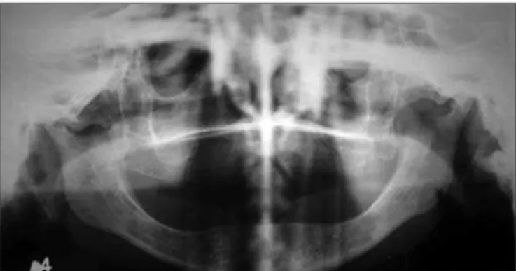 Figura 1. Radiograia panorâmica dentro dos padrões de normalida- normalida-de para idanormalida-de e condição odontológica da paciente