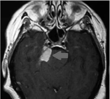 Figura 3. Ressonância magnética nuclear em corte axial com lesão su- su-gestiva de meningioma indicada pela seta