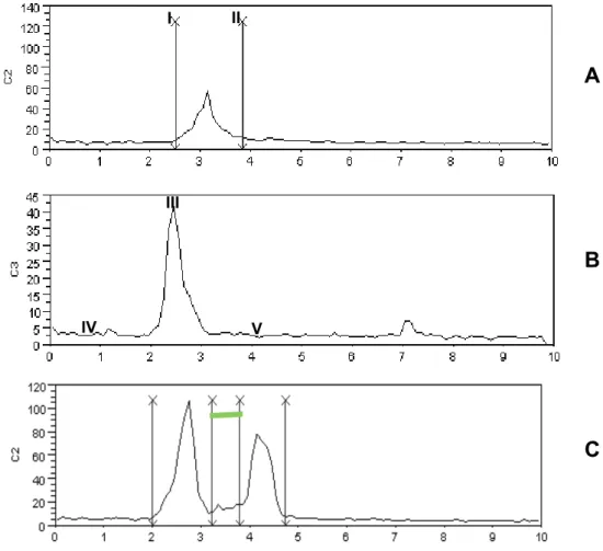 Figure 1 – 1A: onset (I) end of the swallowing (II). 1B: RMS MAX (III), pre-swallowing baseline (IV),  post-swallowing baseline (V)