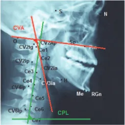 Figure 1 – Anatomical points utilized in the  cephalometric analysis of the CVT/EVT angle