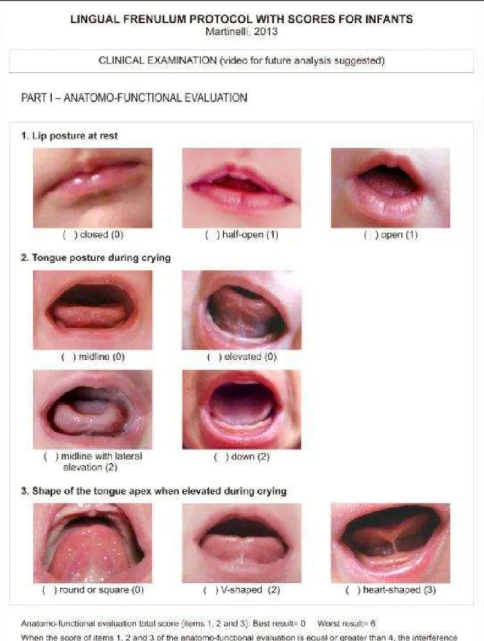 Figure 2 – Frenulum Protocolol for infants – Clinical Exam Part 1