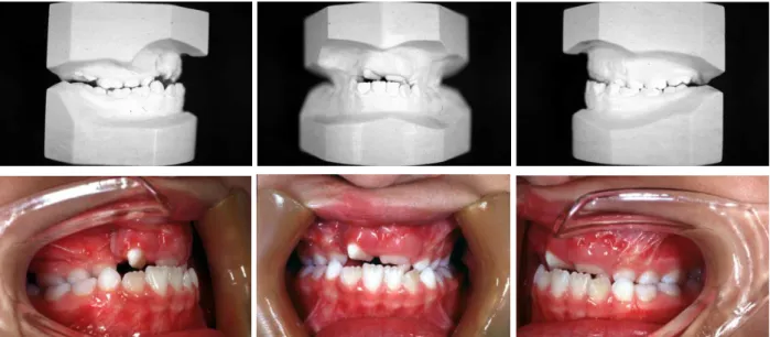 Figure 1 – Individual with complete unilateral right cleft lip and palate presenting Goslon Yardstick 4