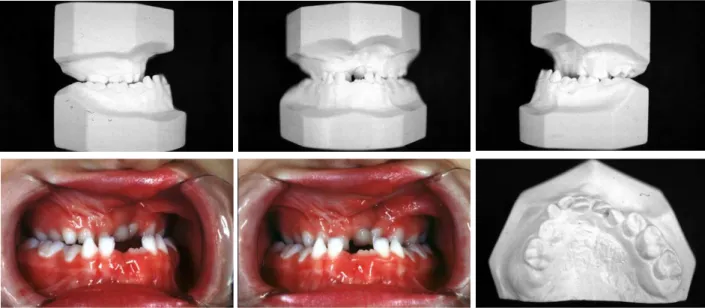Figure 2 – Individual with complete unilateral right cleft lip and palate presenting Goslon Yardstick  5