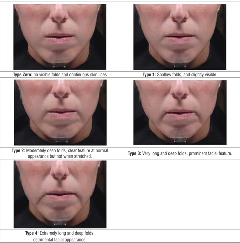 Figure 3. Validated grading scale for marionette lines.