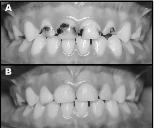 Figure 1 – (A) Initial clinic appearance of maxillary anterior incisors with caries lesions; (B) Clinic  appearance of maxillary incisors after composite resin restoration.