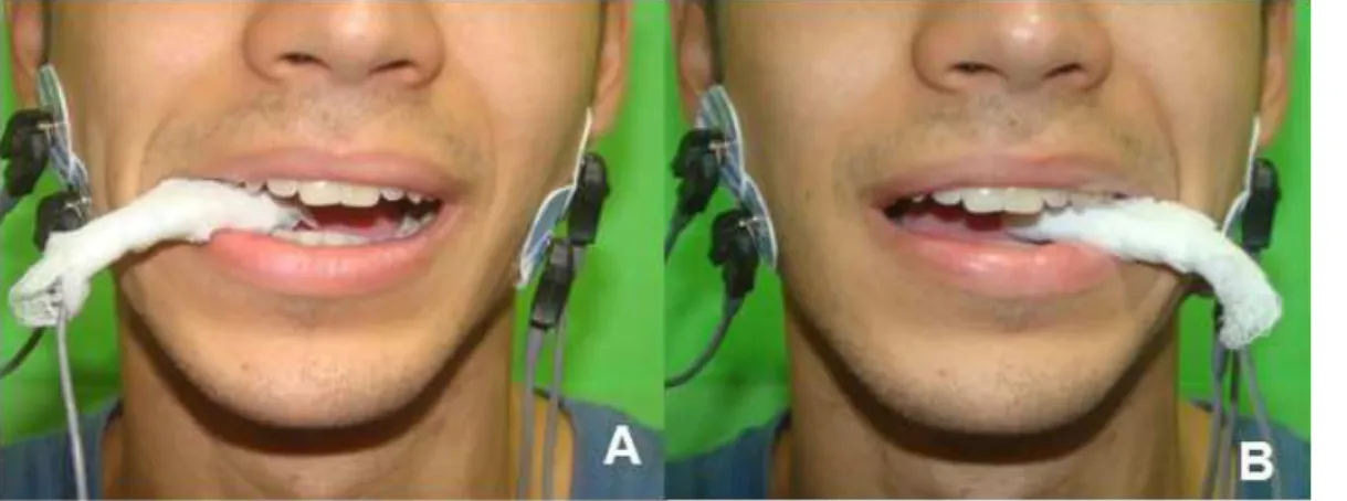 Figure 2.  Positioning of the bite force transducer and the surface electrodes for detection of the electromyographic signal