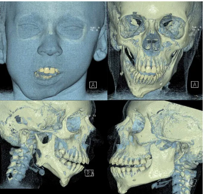 Figure 3.  Computed tomography showing the condylar hypoplasia of the right side. There is also ascending limb shortening of the jaw  and consequent body development defect of the affected side jaw; Three-dimensional reconstructions with A- soft tissue and