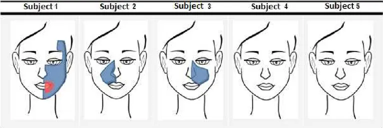 Figure 3.  Face regions affected by dormancy, reported by subjects in the pre (in blue) and  post (in red) Speech, Language and Hearing  Sciences intervention moments