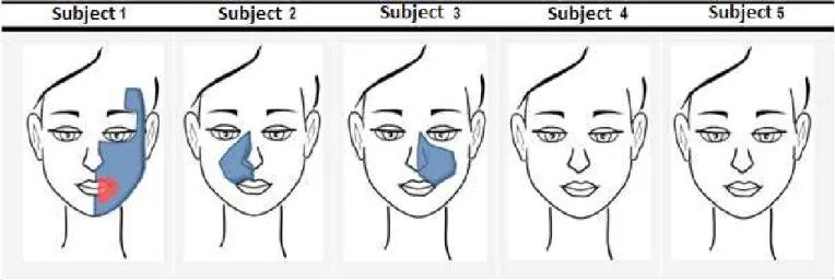 Figure 3.  Face regions affected by dormancy, reported by subjects in the pre (in blue) and  post (in red) Speech, Language and Hearing  Sciences intervention moments