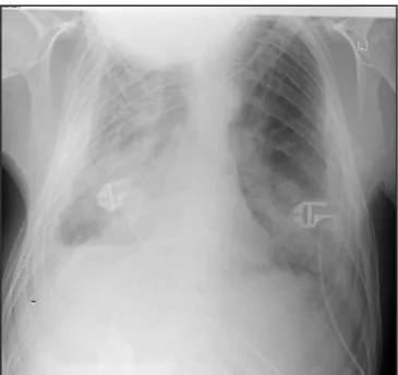 Figure 1 - X-Thorax on Day of Admittance to the ICu