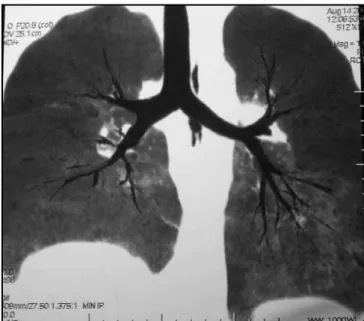 Figure 1 – Computed tomography angiography of the chest  showing filling defects of the vascular arterial structures  pre-vailing in the lower interlobe branches.