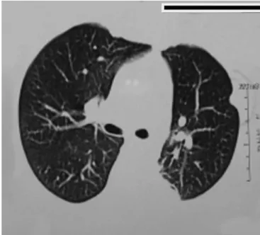 Figure 2 – Chest CT: heterogeneous mass at left lower lobe  basal posterior part.