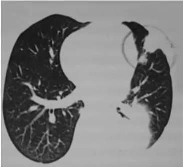 Figure 4 – Chest CT: nodular image at left upper lobe upper  portion, adjacent to the pleura.