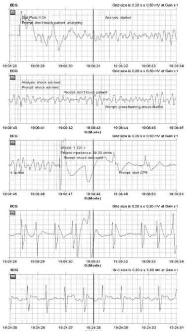 Figure 1. Records of defibrillation by automatic external de- de-fibrillator (AED)