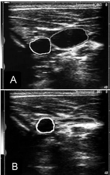 figure 5 – A - Cross sectional axis (short axis) showing  the right carotid artery in yellow and the internal  jugu-lar  vein  in  green;  B  -  Signs  of  collapse  of  the  internal  jugular  vein  upon  performance  of  probe  compression  (compressibil