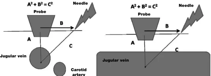 figure 6 – A - Needle positioning and insertion, cross-sectional axis; B - longitudinal axis.