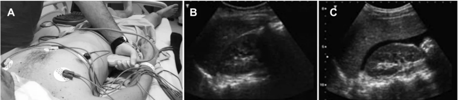 Figure 6 - A- Probe on the splenorenal space; B- normal ultrasonography image; C- peri-splenic space luid.