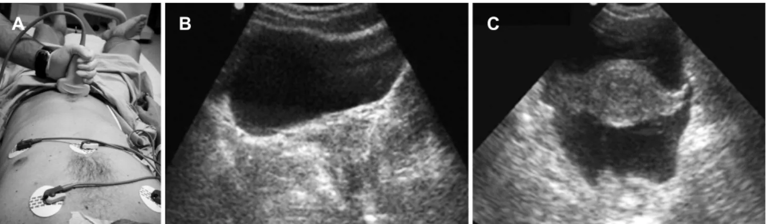 Figure 7 – A- probe on left diaphragm/lung parenchyma intersection; B- left chest cavity image without luid; C-  left chest  cavity luid (pleural efusion).