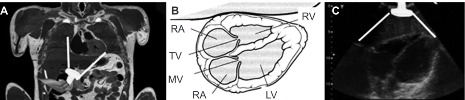 Figure 10 – A- probe on sub-xyfoid region, using liver as acoustic window; B- heart structures anatomical identiication (ultra- (ultra-sound image); C- heart image from sub-xyfoid window.