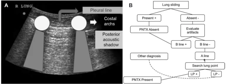 Figure 12 - Lung point (LP) ultrasound sign .PNTX = pneumothorax.