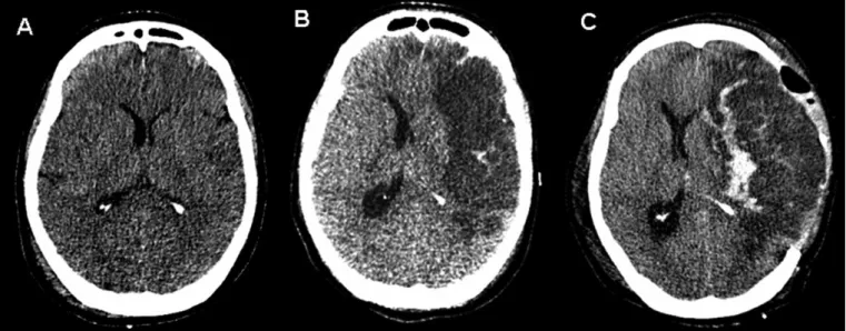 Figure 2 - A) Head computed tomography showing the initially mild asymmetric lateral ventricles, suggesting brain edema likely  from ischemia