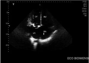 Figure 3 - Transthoracic echocardiogram performed after the operation, demonstrating  the bioprosthetic in a normofunctioning mitral position