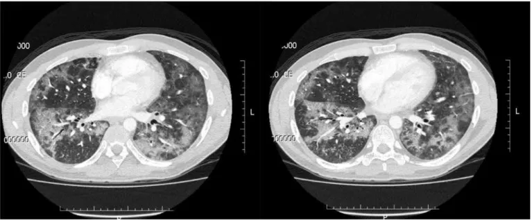 Figure 1 - Thoracic computed tomography at admission.  Extensive opacities with a predominantly “ground glass” appearance and bilateral diffuse involvement.