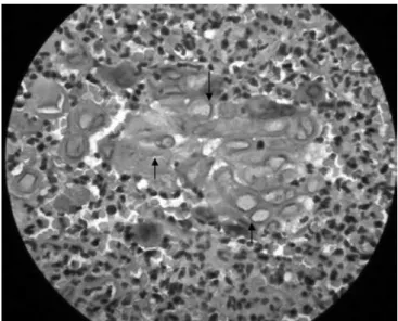 Figure 6 - Macroscopic aspect of a lesion excised from the  tongue. 