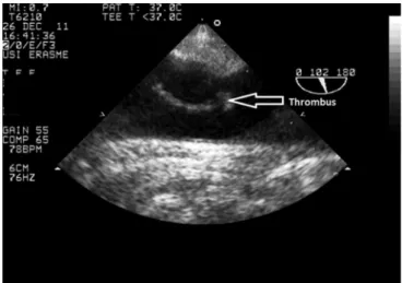Figure 1 - Transverse view of descending aorta. An intramural hematoma and  intraluminal clot are visualized at 40cm from the dental arch.