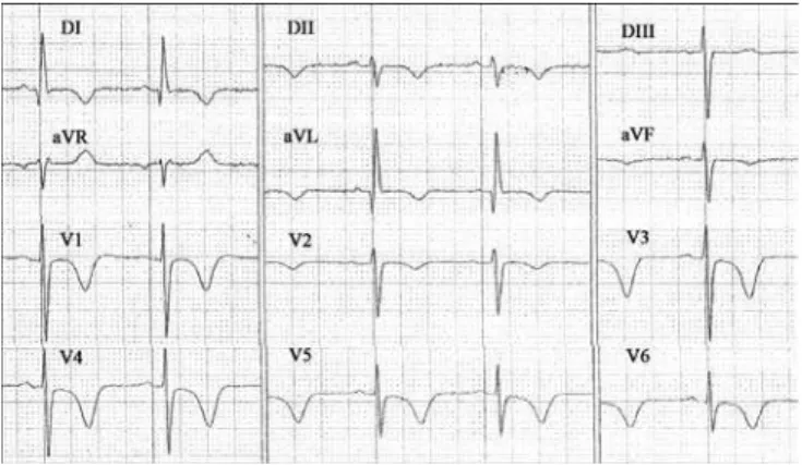 Figure 3 - Electrocardiograms performed on hospitalization day four at the  intensive care unit