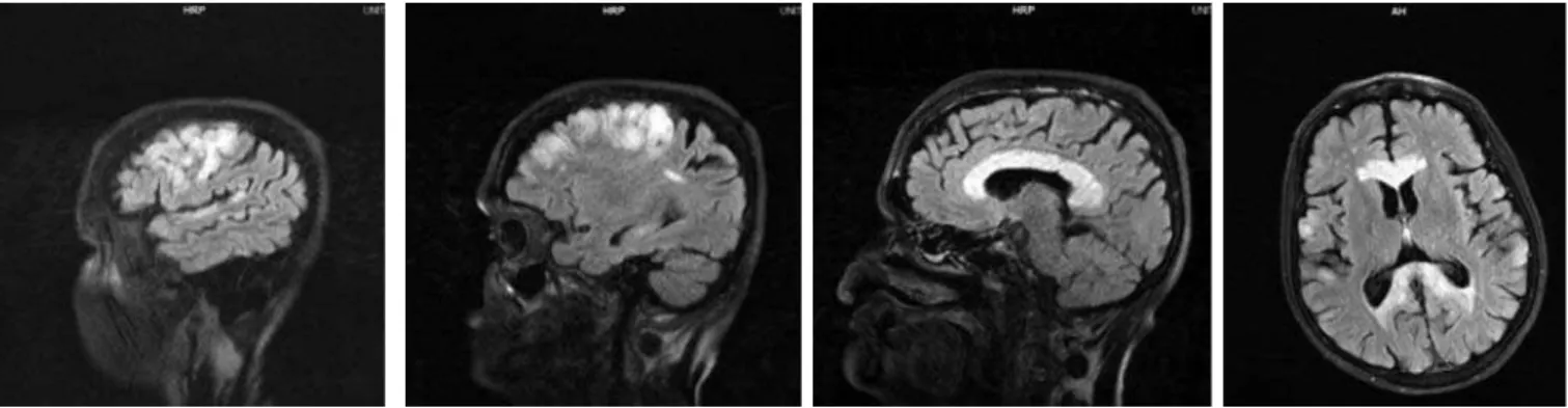 Figure 2 – T2-weighted MRI images showing hyperintense lesions in the corpus callosum.