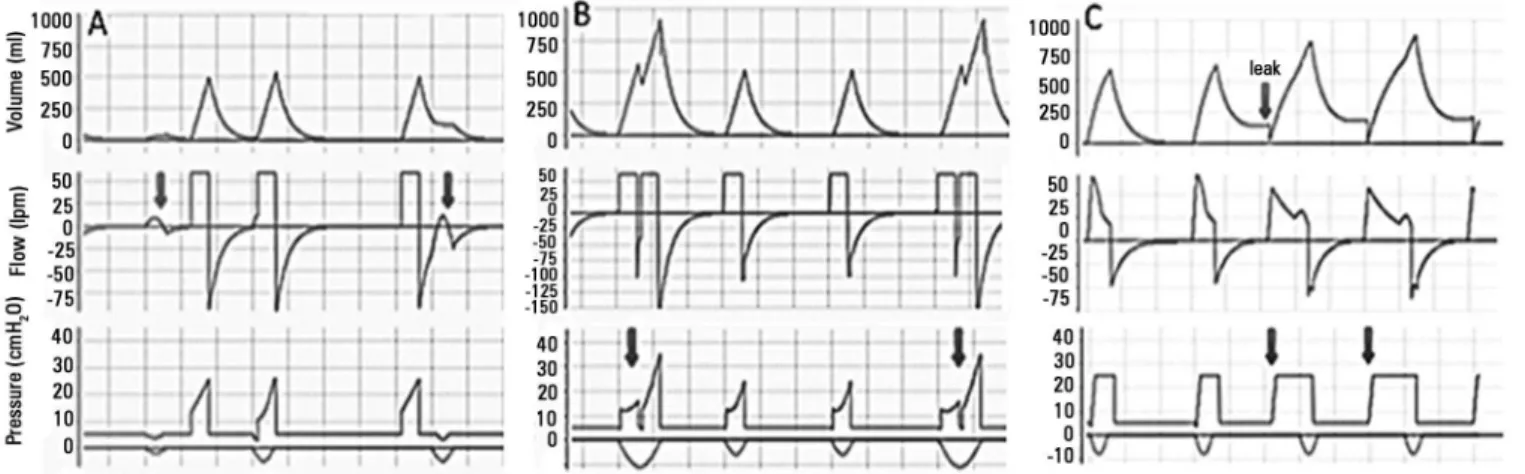Figure 1 - Trigger asynchronies identified in volume-, flow- and pressure-time curves, indicated by arrows