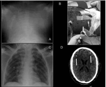 Figure 1 - Thoracic and central nervous system images. (A) The chest X-Ray after  ECMO cannulation; (B) The cutaneous appearance of the patient