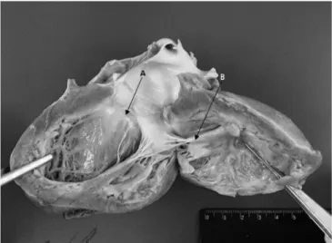 Figure 3 - Macroscopy of the left ventricle. (A) Thickening of the mitral valve. 