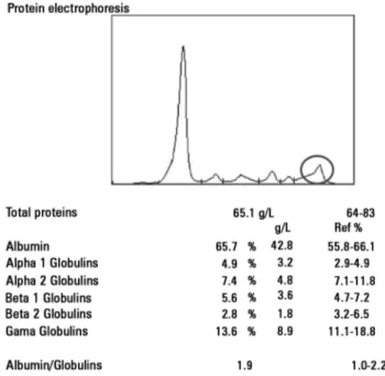 Figure 1 - Protein electrophoresis in the acute phase, showing no alterations  regarding the gamma-globulin region.