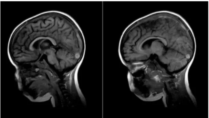 Figure 1 - Sagittal view in T1-weighted sequence.