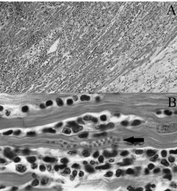 Figure 2 - Histology of an explanted heart sample. A) Photomicrograph (x400) of  an hematoxylin and eosin stained sample