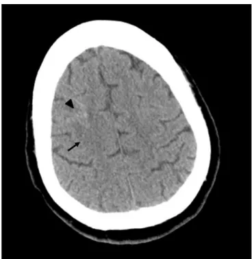 Figure 1 - Cortico-subcortical right frontal hypodensity (arrow) with mild  hyperdensity (arrow head) - ischemic area with intracerebral hemorrhagic  component observed on brain computerized tomography.
