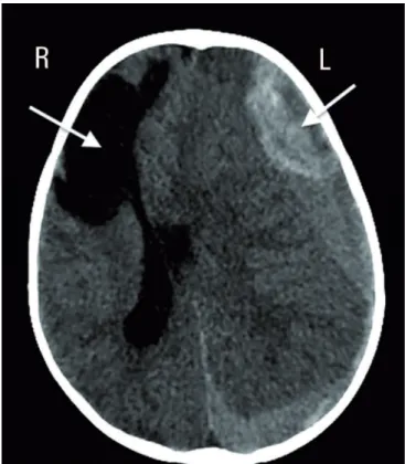Figure 1 - Initial computed tomography scan of the skull: evidence of a brain  cyst on the right and intracranial hemorrhage on the left (arrows), with signs of  intracranial hemorrhage and midline shift.