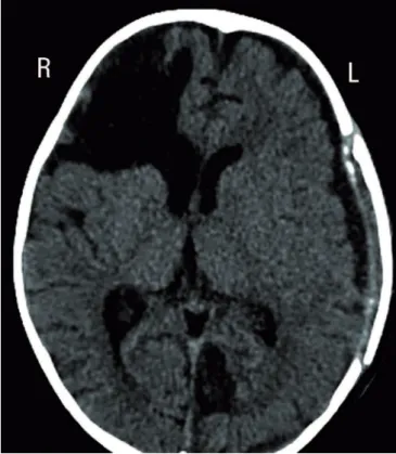 Figure 2 - Computed tomography scan of the skull prior to discharge showing  brain remodeling.