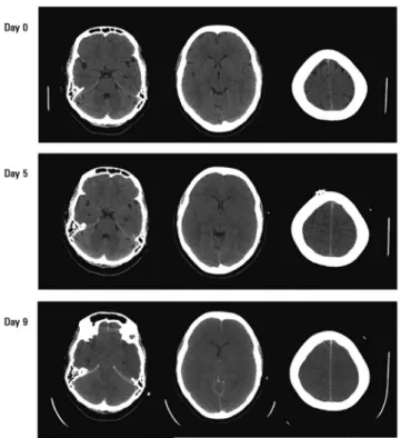 Figure 1 - Sequential computed tomography of the brain in a 37 year old female  patient admitted due to acute liver failure, hepatic encephalopathy and the need for  ventilatory support