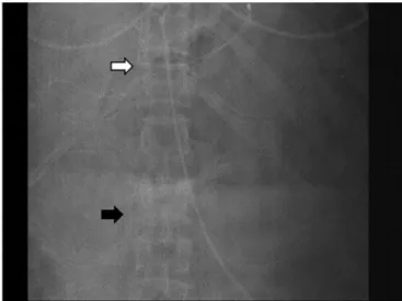 Figure 1 - Double lumen cannula and inferior vena cava filter.  Inferior vena cava filter and  tip of the double lumen cannula was confirmed with daily x-rays due to potential filter migration