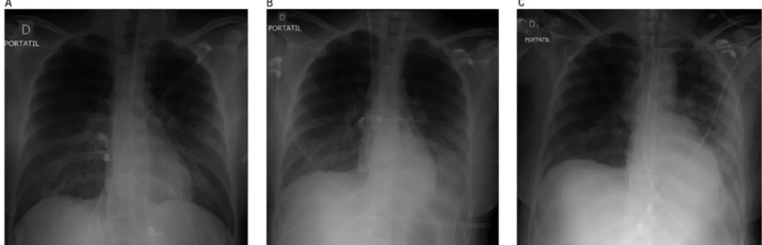 Figure 1 - Chest-X-ray on A) admission (left), B) the first day (center) and C) the 6 th  day (right) showing bilateral infiltrates suggesting acute respiratory distress syndrome.
