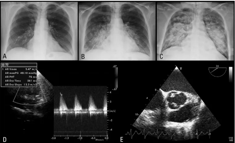 Figure 1 - (A to C) - Radiologic evolution - progressive worsening of pulmonary interstitial edema