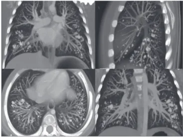 Figure 1 - Pelvic X-ray showing osteolytic lesions (arrows). Figure 2 - Computed chest tomography showing alveolar calcification.