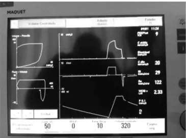 Figure 2 - Parameters and ventilatory mechanics before heliox administration. 
