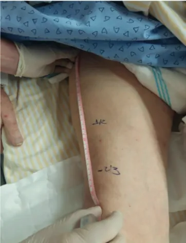 Figure 1 - Reference points for measuring the thickness of the quadriceps muscle.