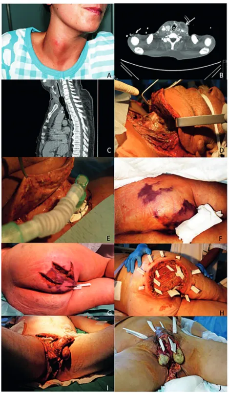 Figure 3 - (A) Female patient presenting with cervical abscess prior to surgical drainage