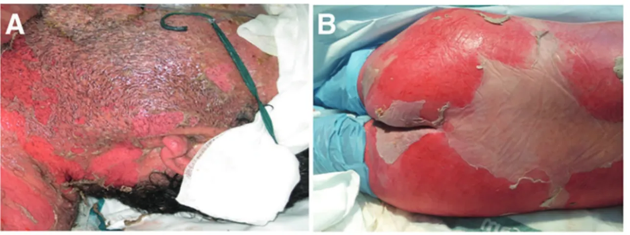 Table 1 - Classification of exfoliative blistering lesions according to Bastuji-Garin et al